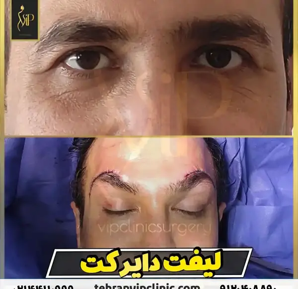 عکس قبل و بعد لیفت مژه و ابرو