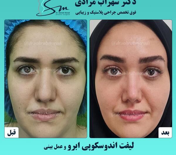 عکس قبل و بعد لیفت مژه و ابرو