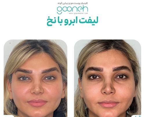 عکس قبل و بعد لیفت مژه و ابرو
