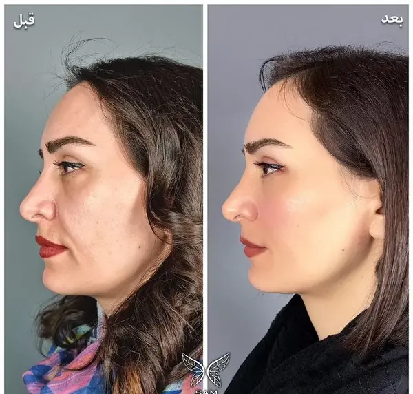 عکس قبل و بعد لیفت مژه و ابرو