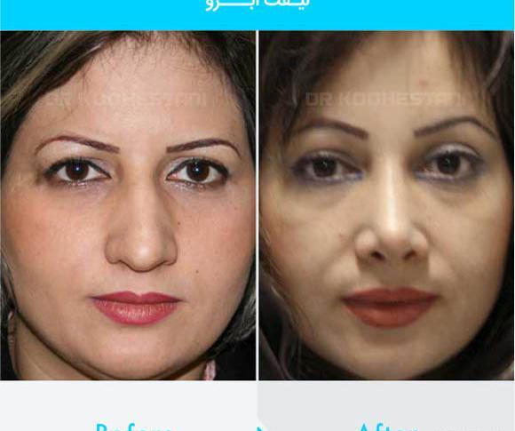 عکس قبل و بعد لیفت مژه و ابرو