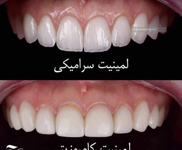 عکس قبل و بعد کامپوزیت نی نی سایت
