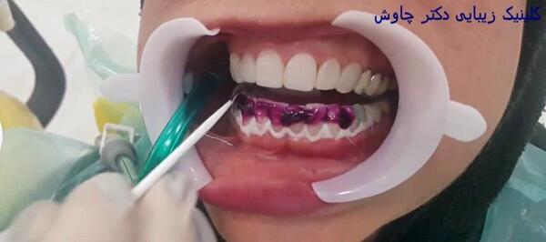 عکس قبل و بعد کامپوزیت نی نی سایت