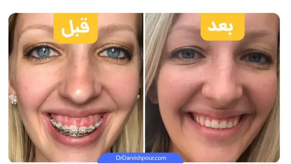 عکس قبل و بعد کامپوزیت نی نی سایت