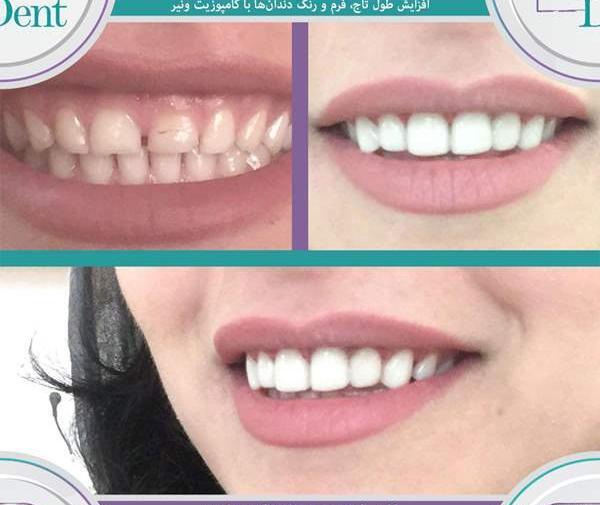 عکس قبل و بعد کامپوزیت نی نی سایت
