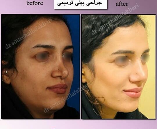 عکس گرفتن قبل عمل بینی