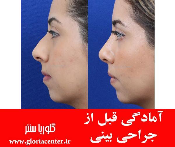عکس گرفتن قبل عمل بینی