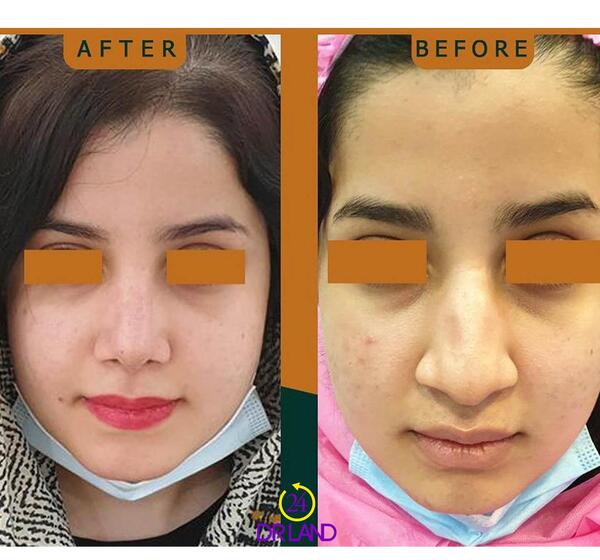 عکس گرفتن قبل عمل بینی