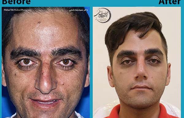 عکس گرفتن قبل عمل بینی