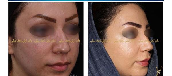 عکس گرفتن قبل عمل بینی
