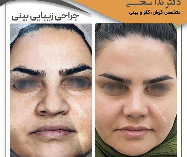عکس گرفتن قبل عمل بینی