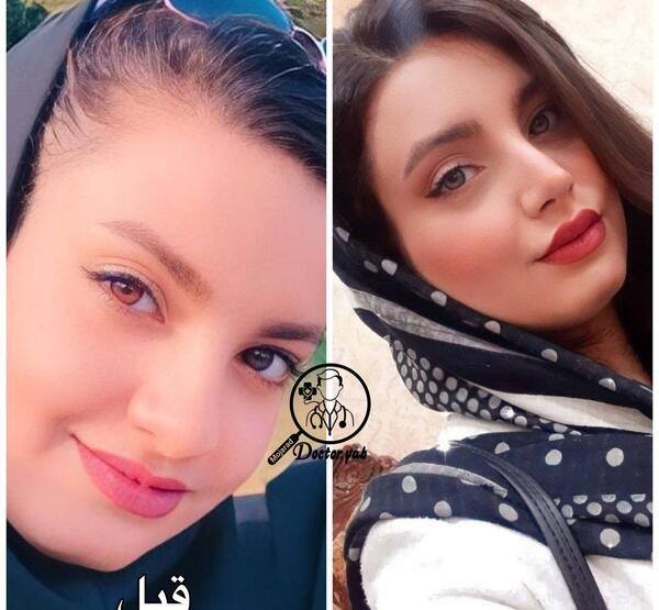 عکس گرفتن قبل عمل بینی