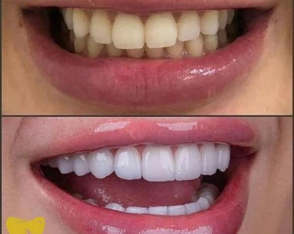 عکس های قبل و بعد کامپوزیت دندان