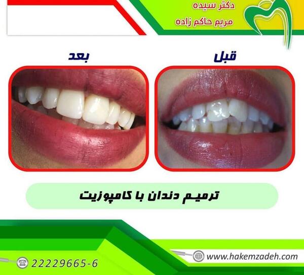 عکس های قبل و بعد کامپوزیت دندان