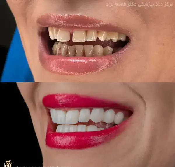 عکس های قبل و بعد کامپوزیت دندان