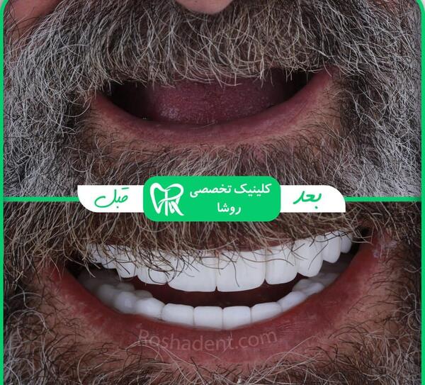 عکس های قبل و بعد کامپوزیت دندان