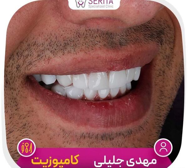 عکس های قبل و بعد کامپوزیت دندان