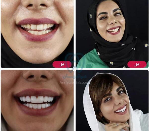 عکس های قبل و بعد کامپوزیت دندان