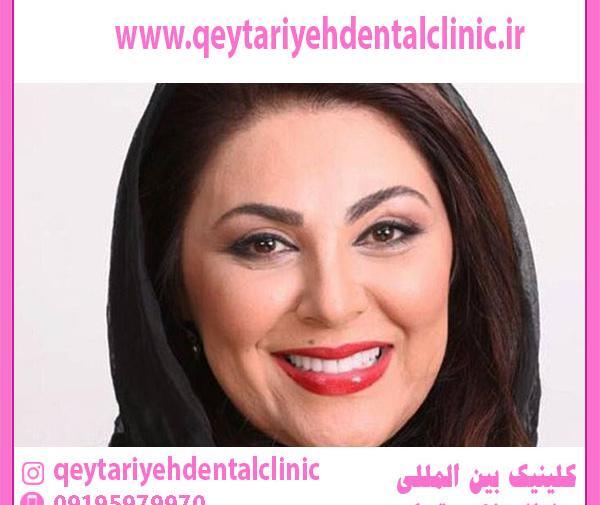 عکس های قبل و بعد کامپوزیت دندان