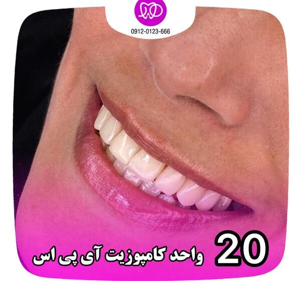 عکس قبل و بعد کامپوزیت ونیر