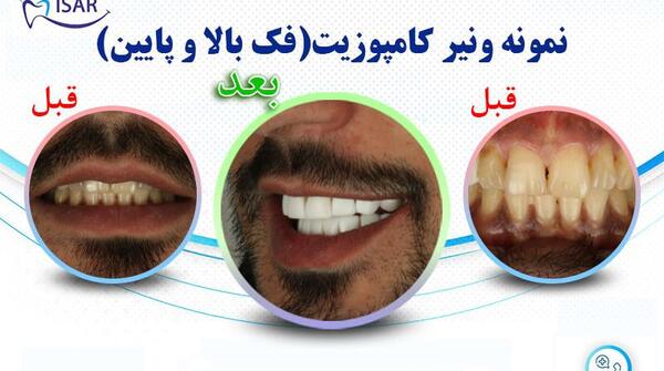 عکس قبل و بعد کامپوزیت ونیر
