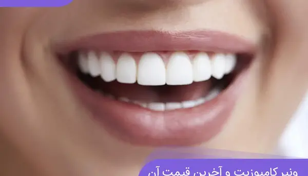 عکس قبل و بعد از کامپوزیت دندان