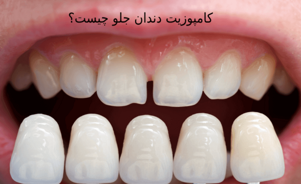 عکس قبل و بعد از کامپوزیت دندان