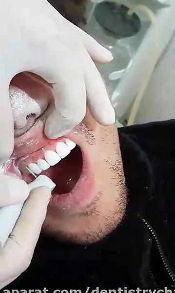 عکس قبل و بعد پالیش کامپوزیت