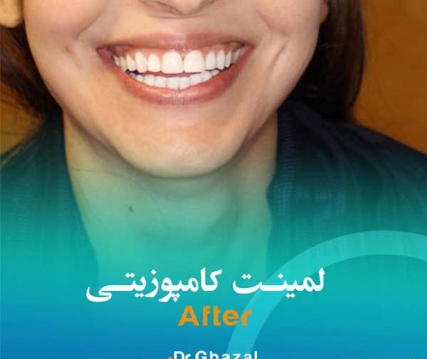 عکس قبل و بعد پالیش کامپوزیت