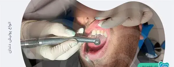 عکس قبل و بعد پالیش کامپوزیت