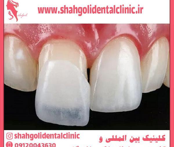 عکس قبل و بعد پالیش کامپوزیت