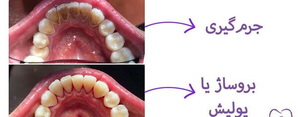 عکس قبل و بعد پالیش کامپوزیت