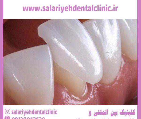 عکس قبل و بعد پالیش کامپوزیت