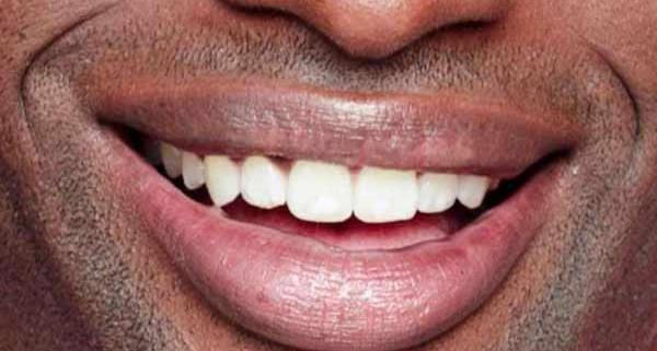 عکس قبل و بعد پالیش کامپوزیت