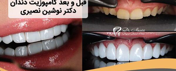 عکس های قبل و بعد کامپوزیت