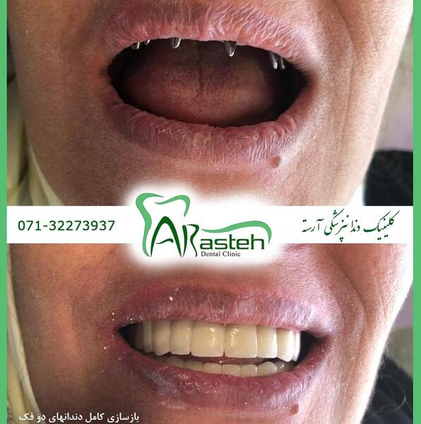 عکس های قبل و بعد کامپوزیت