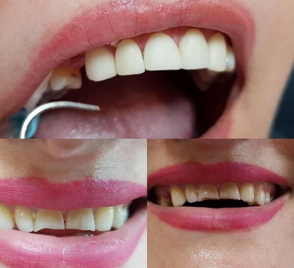 عکس های قبل و بعد کامپوزیت
