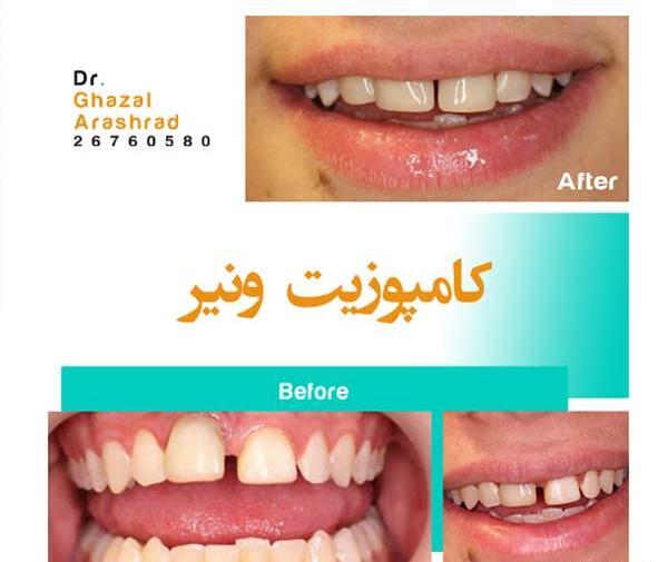 عکس های قبل و بعد کامپوزیت