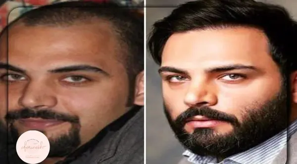 عکس های احسان علیخانی قبل و بعد از کاشت مو