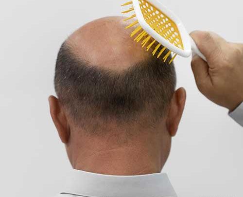عکس های احسان علیخانی قبل و بعد از کاشت مو