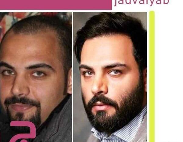 عکس های احسان علیخانی قبل و بعد از کاشت مو