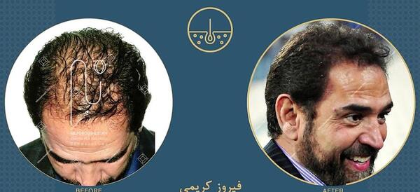 عکس های احسان علیخانی قبل کاشت مو