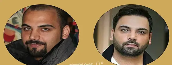 عکس های احسان علیخانی قبل کاشت مو