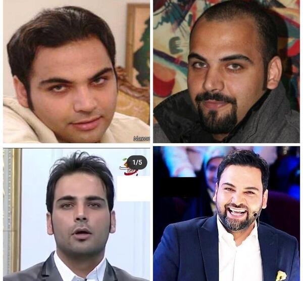 عکس های احسان علیخانی قبل کاشت مو