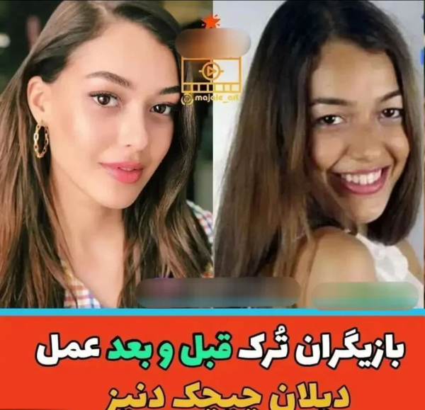 عکس قبل از عمل فحریه اوجن