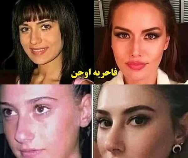 عکس قبل از عمل فحریه اوجن