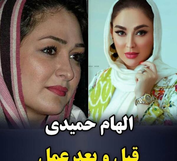 عکس قبل و بعد عمل رزیتا غفاری