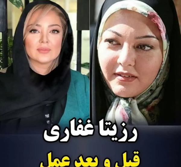 عکس قبل و بعد عمل رزیتا غفاری
