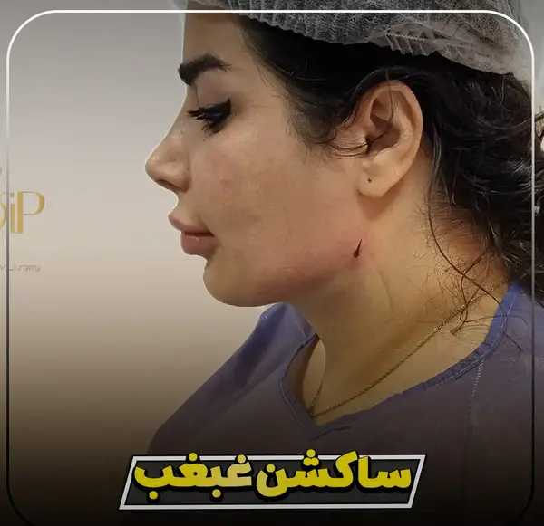 عکس های قبل و بعد از عمل غبغب