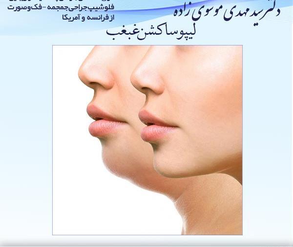 عکس های قبل و بعد از عمل غبغب